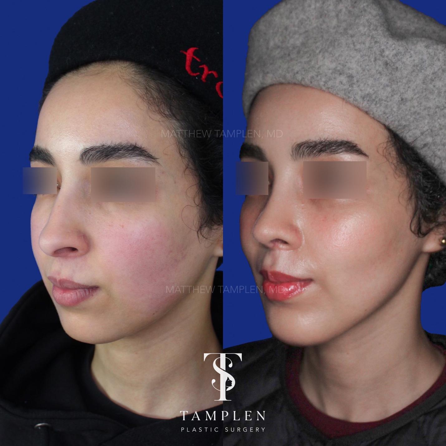 Buccal Fat Removel Image 1