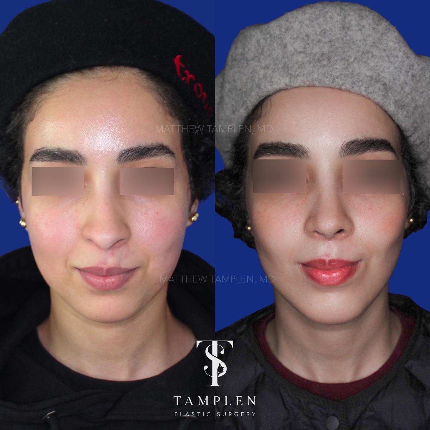 Buccal Fat Removel Image 2