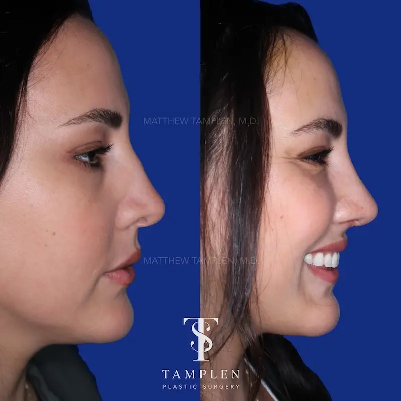 Revision Rhinoplasty - Nasal Surgery Patient