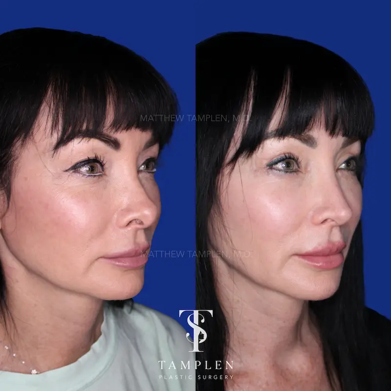 Revision Rhinoplasty - Nasal Surgery Patient