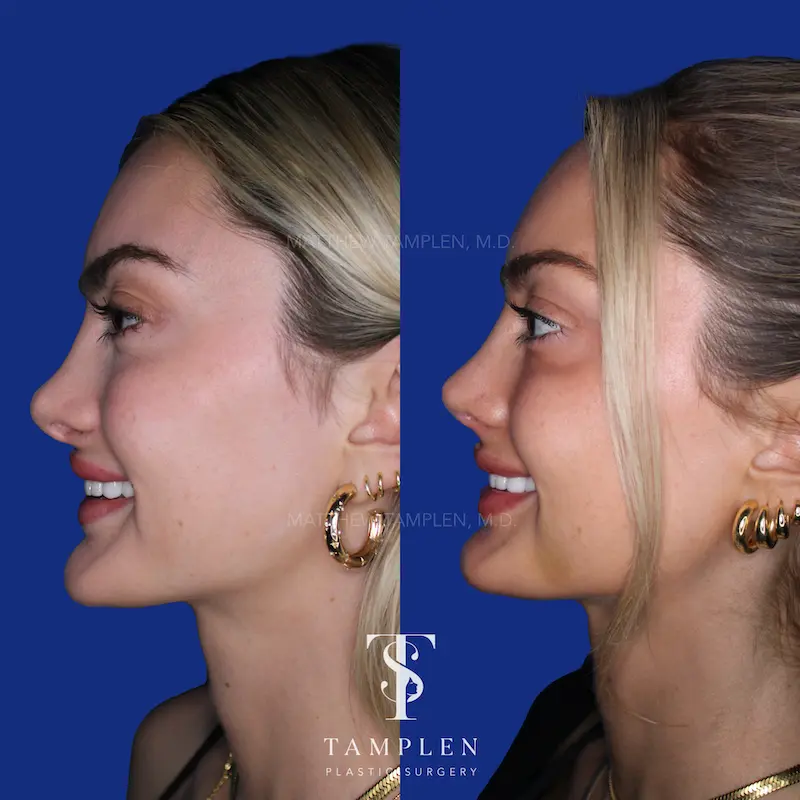 Revision Rhinoplasty - Nasal Surgery Patient