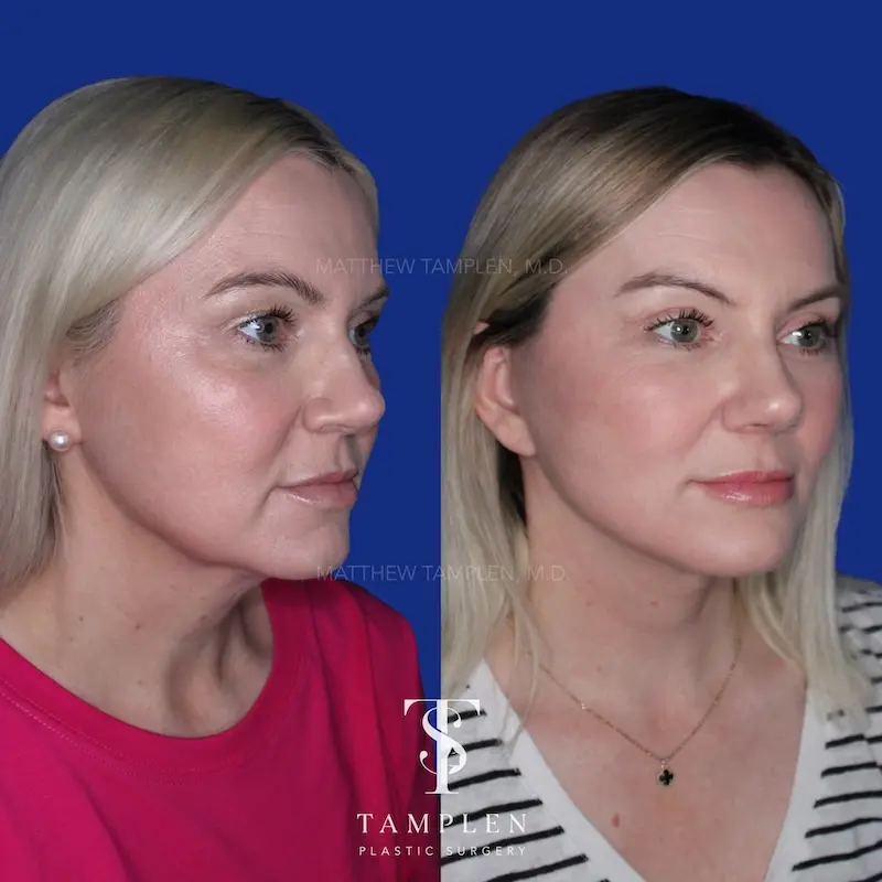 Endoscopic lateral brow lift before and after – Fox Eye Lift results by Dr. Tamplen