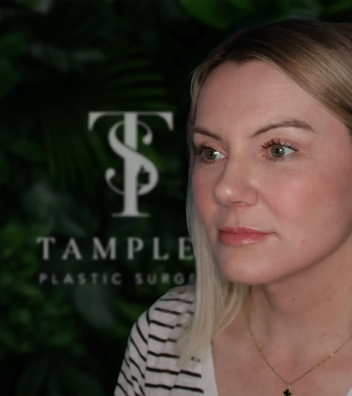 Female patient facelift results at Tamplen Plastic Surgery